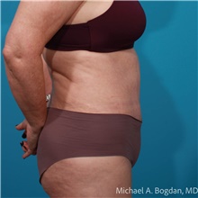 Tummy Tuck After Photo by Michael Bogdan, MD, MBA, FACS; Grapevine, TX - Case 48074