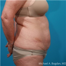 Tummy Tuck Before Photo by Michael Bogdan, MD, MBA, FACS; Grapevine, TX - Case 48074