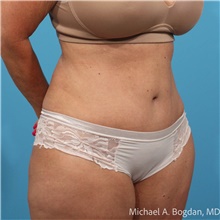 Tummy Tuck After Photo by Michael Bogdan, MD, MBA, FACS; Grapevine, TX - Case 48075