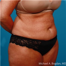 Tummy Tuck Before Photo by Michael Bogdan, MD, MBA, FACS; Grapevine, TX - Case 48075
