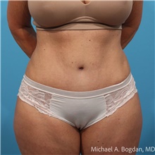 Tummy Tuck After Photo by Michael Bogdan, MD, MBA, FACS; Grapevine, TX - Case 48075