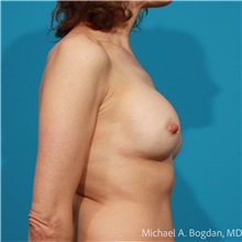 Breast Implant Revision After Photo by Michael Bogdan, MD, MBA, FACS; Grapevine, TX - Case 48080