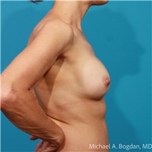 Breast Implant Revision Before Photo by Michael Bogdan, MD, MBA, FACS; Grapevine, TX - Case 48080