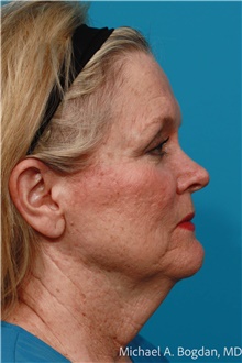 Facelift Before Photo by Michael Bogdan, MD, MBA, FACS; Grapevine, TX - Case 48081