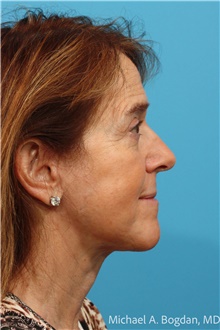 Facelift After Photo by Michael Bogdan, MD, MBA, FACS; Grapevine, TX - Case 48082