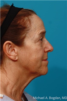Facelift Before Photo by Michael Bogdan, MD, MBA, FACS; Grapevine, TX - Case 48082