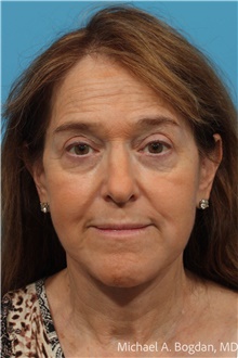Facelift After Photo by Michael Bogdan, MD, MBA, FACS; Grapevine, TX - Case 48082