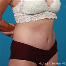 Tummy Tuck After Photo by Michael Bogdan, MD, MBA, FACS; Grapevine, TX - Case 48083