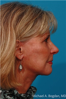 Facelift After Photo by Michael Bogdan, MD, MBA, FACS; Grapevine, TX - Case 48084