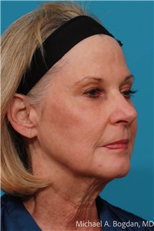 Facelift Before Photo by Michael Bogdan, MD, MBA, FACS; Grapevine, TX - Case 48084