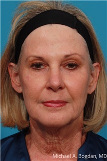 Facelift Before Photo by Michael Bogdan, MD, MBA, FACS; Grapevine, TX - Case 48084
