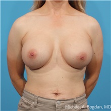 Breast Augmentation After Photo by Michael Bogdan, MD, MBA, FACS; Grapevine, TX - Case 48086