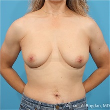 Breast Augmentation Before Photo by Michael Bogdan, MD, MBA, FACS; Grapevine, TX - Case 48086
