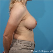 Breast Augmentation After Photo by Michael Bogdan, MD, MBA, FACS; Grapevine, TX - Case 48086