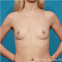 Breast Augmentation Before Photo by Michael Bogdan, MD, MBA, FACS; Grapevine, TX - Case 48087
