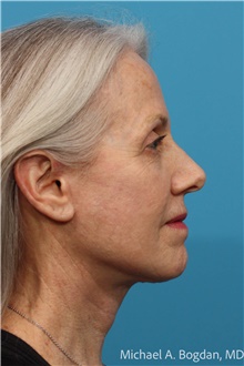 Facelift After Photo by Michael Bogdan, MD, MBA, FACS; Grapevine, TX - Case 48088