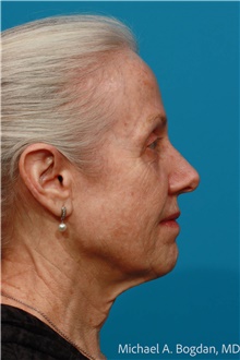 Facelift Before Photo by Michael Bogdan, MD, MBA, FACS; Grapevine, TX - Case 48088