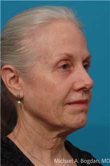 Facelift Before Photo by Michael Bogdan, MD, MBA, FACS; Grapevine, TX - Case 48088