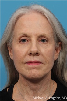 Facelift After Photo by Michael Bogdan, MD, MBA, FACS; Grapevine, TX - Case 48088