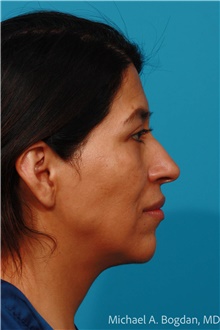 Eyelid Surgery After Photo by Michael Bogdan, MD, MBA, FACS; Grapevine, TX - Case 48144