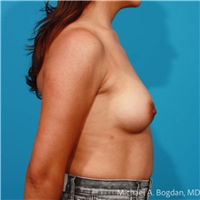 Breast Augmentation After Photo by Michael Bogdan, MD, MBA, FACS; Grapevine, TX - Case 48145