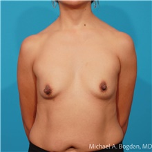 Breast Augmentation Before Photo by Michael Bogdan, MD, MBA, FACS; Grapevine, TX - Case 48145