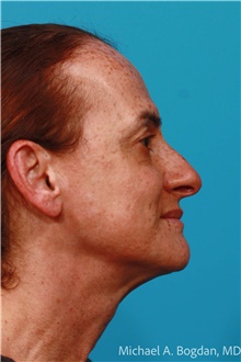 Facelift Before Photo by Michael Bogdan, MD, MBA, FACS; Grapevine, TX - Case 48148