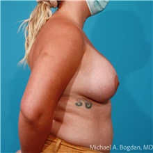 Breast Augmentation After Photo by Michael Bogdan, MD, MBA, FACS; Grapevine, TX - Case 48153