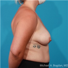 Breast Augmentation Before Photo by Michael Bogdan, MD, MBA, FACS; Grapevine, TX - Case 48153