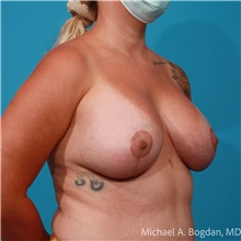 Breast Augmentation After Photo by Michael Bogdan, MD, MBA, FACS; Grapevine, TX - Case 48153