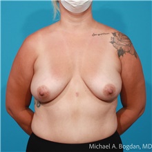 Breast Augmentation Before Photo by Michael Bogdan, MD, MBA, FACS; Grapevine, TX - Case 48153