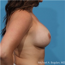 Breast Implant Revision After Photo by Michael Bogdan, MD, MBA, FACS; Grapevine, TX - Case 48182