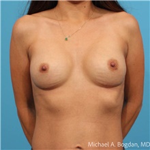 Breast Augmentation After Photo by Michael Bogdan, MD, MBA, FACS; Grapevine, TX - Case 48184