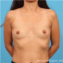 Breast Augmentation Before Photo by Michael Bogdan, MD, MBA, FACS; Grapevine, TX - Case 48184