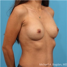 Breast Augmentation After Photo by Michael Bogdan, MD, MBA, FACS; Grapevine, TX - Case 48184