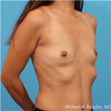 Breast Augmentation Before Photo by Michael Bogdan, MD, MBA, FACS; Grapevine, TX - Case 48184