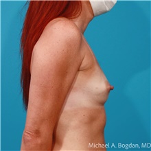 Breast Augmentation Before Photo by Michael Bogdan, MD, MBA, FACS; Grapevine, TX - Case 48185