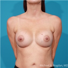 Breast Augmentation After Photo by Michael Bogdan, MD, MBA, FACS; Grapevine, TX - Case 48185