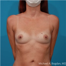Breast Augmentation Before Photo by Michael Bogdan, MD, MBA, FACS; Grapevine, TX - Case 48185
