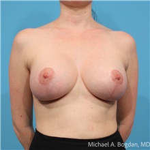Breast Augmentation After Photo by Michael Bogdan, MD, MBA, FACS; Grapevine, TX - Case 48186