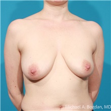 Breast Augmentation Before Photo by Michael Bogdan, MD, MBA, FACS; Grapevine, TX - Case 48186