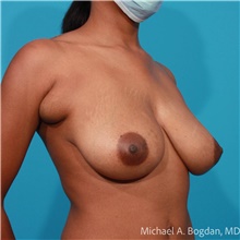 Breast Lift Before Photo by Michael Bogdan, MD, MBA, FACS; Grapevine, TX - Case 48188