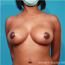 Breast Lift After Photo by Michael Bogdan, MD, MBA, FACS; Grapevine, TX - Case 48188