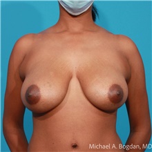 Breast Lift Before Photo by Michael Bogdan, MD, MBA, FACS; Grapevine, TX - Case 48188