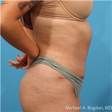 Tummy Tuck After Photo by Michael Bogdan, MD, MBA, FACS; Grapevine, TX - Case 48189