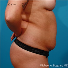 Tummy Tuck Before Photo by Michael Bogdan, MD, MBA, FACS; Grapevine, TX - Case 48189