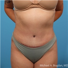 Tummy Tuck After Photo by Michael Bogdan, MD, MBA, FACS; Grapevine, TX - Case 48189