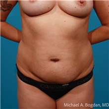 Tummy Tuck Before Photo by Michael Bogdan, MD, MBA, FACS; Grapevine, TX - Case 48189