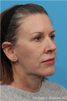Facelift After Photo by Michael Bogdan, MD, MBA, FACS; Grapevine, TX - Case 48191