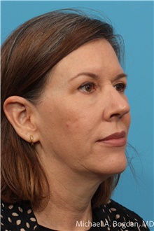 Facelift Before Photo by Michael Bogdan, MD, MBA, FACS; Grapevine, TX - Case 48191